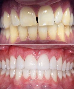 Porcelain veneers, before and after