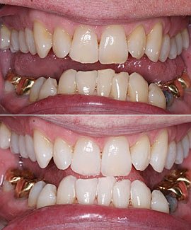 dr george's teeth whitening system