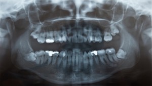 X-ray showing problematic wisdom teeth