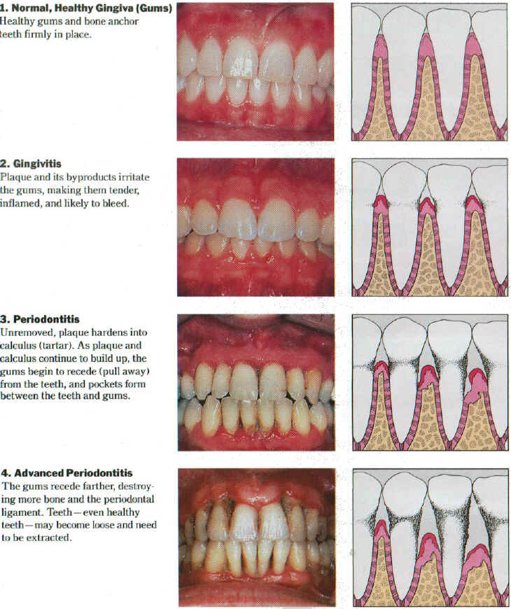 stages_of_perio